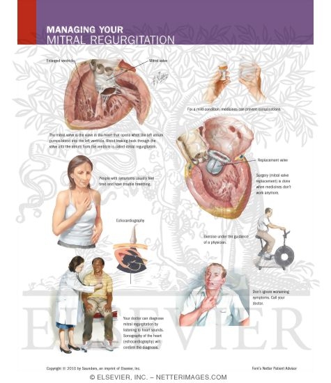 Watermarked preview of labeled image: Managing Your Mitral Regurgitation