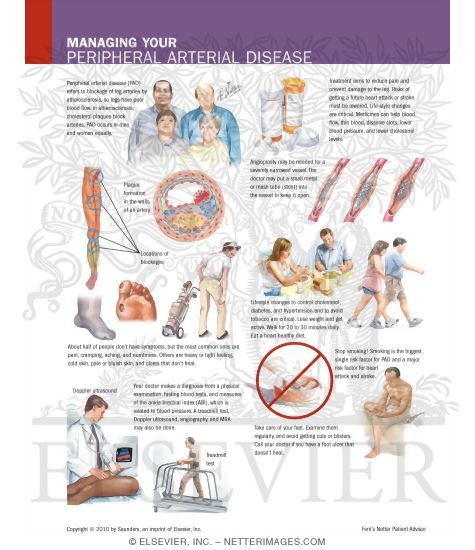 Watermarked preview of labeled image: Managing Your Peripheral Arterial Disease
