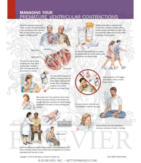 Watermarked preview of labeled image: Managing Your Premature Ventricular Contractions