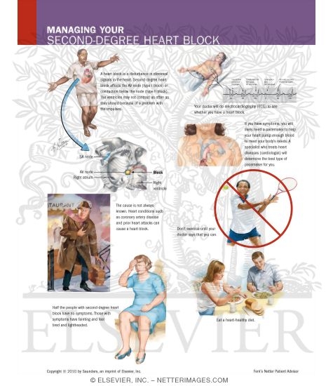 Watermarked preview of labeled image: Managing Your Second-Degree Heart Block