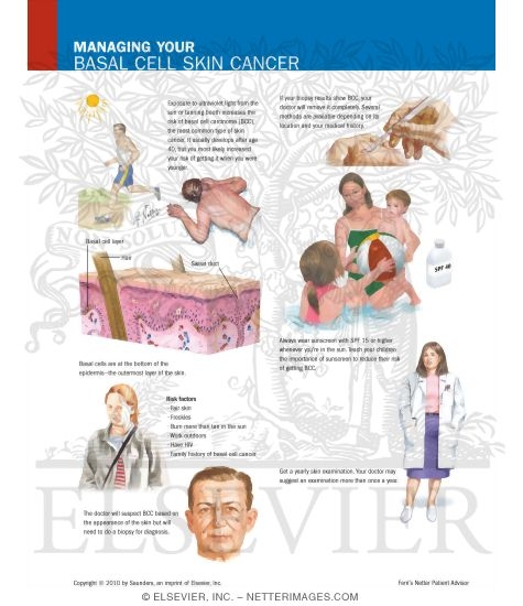 Managing Your Basal Cell Skin Cancer