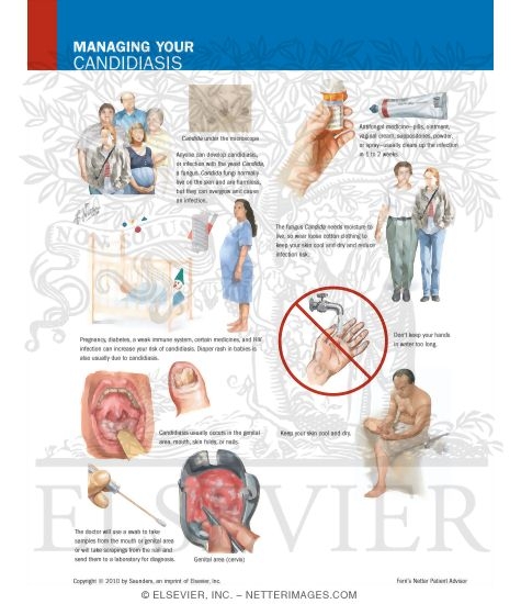 Watermarked preview of labeled image: Managing Your Candidiasis