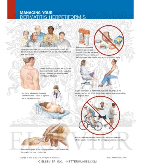 Watermarked preview of labeled image: Managing Your Dermatitis Herpetiformis