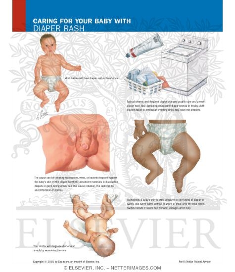Caring for Your Baby With Diaper Rash