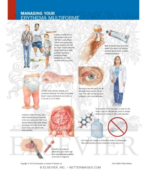 Watermarked preview of labeled image: Managing Your Erythema Multiforme
