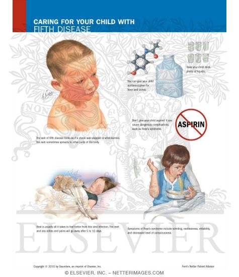 Caring for Your Child With Fifth Disease