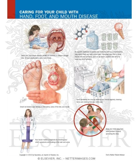 Caring for Your Child With Hand, Foot, and Mouth Disease