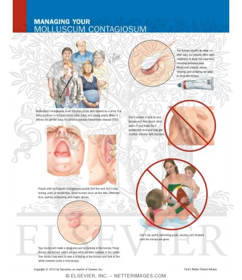 Managing Your Molluscum Contagiosum