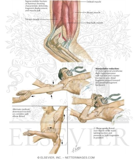 Watermarked preview of labeled image: Supracondylar Fracture
