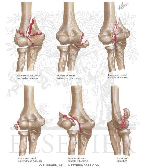 Condylar Fractures of the Humerus