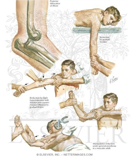 Watermarked preview of labeled image: Posterior Dislocation of the Elbow
