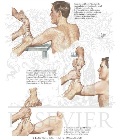 Colles' Fracture: Reduction By Manipulation