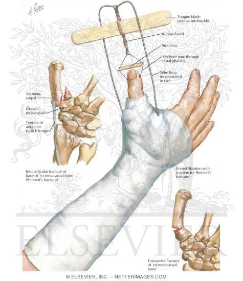 Fracture of First Metacarpal