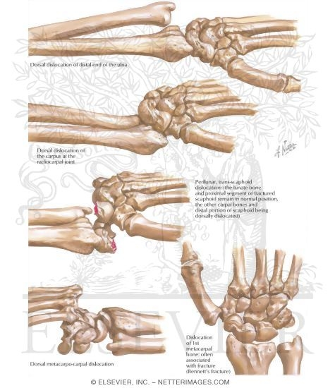 Watermarked preview of labeled image: Dislocations of the Wrist