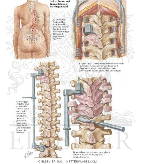 Watermarked preview of labeled image: Spinal Fusion