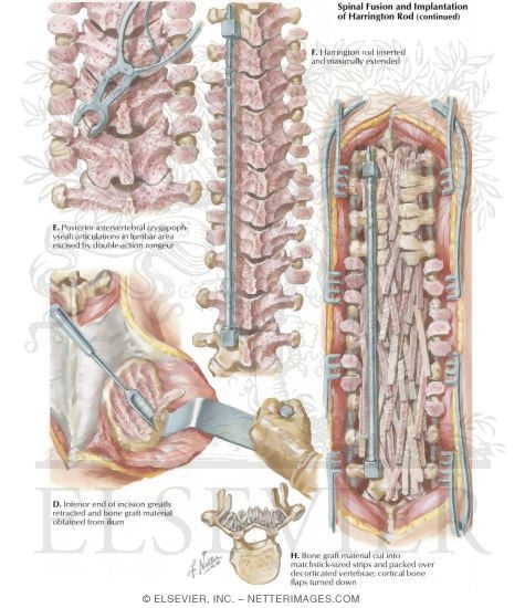 Watermarked preview of labeled image: Spinal Fusion