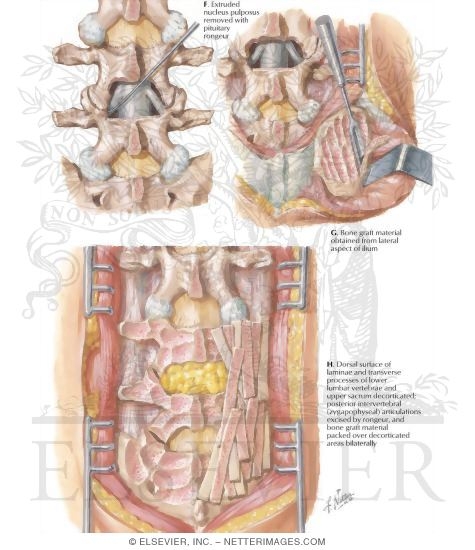 Watermarked preview of labeled image: Removal of Herniated Disc: Fusion