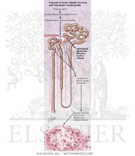 Vasomotor Nephropathy