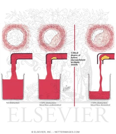Watermarked preview of labeled image: Critical Point Of Lumen Obstruction