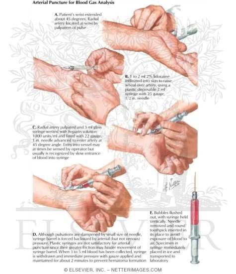 Arterial Puncture for Blood Gas Analysis