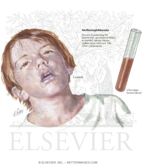 Methemoglobinemia