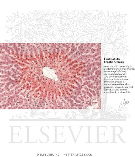 Centrilobular Hepatic Necrosis