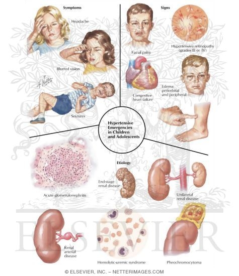 Hypertensive Emergencies In Children and Adults