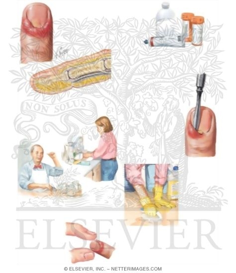 Watermarked preview of unlabeled image: Managing Your Paronychia