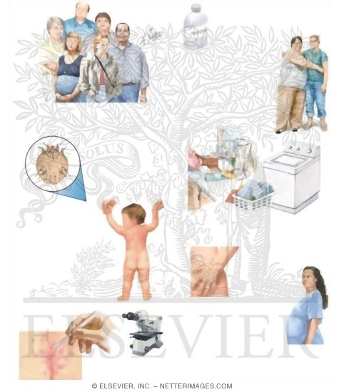 Watermarked preview of unlabeled image: Managing Scabies