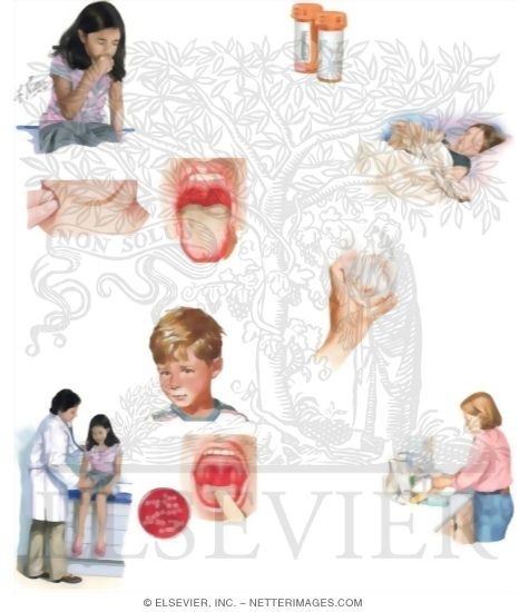 Watermarked preview of unlabeled image: Caring for Your Child With Scarlet Fever