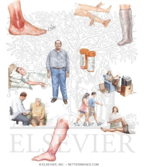 Watermarked preview of unlabeled image: Managing Your Stasis Dermatitis