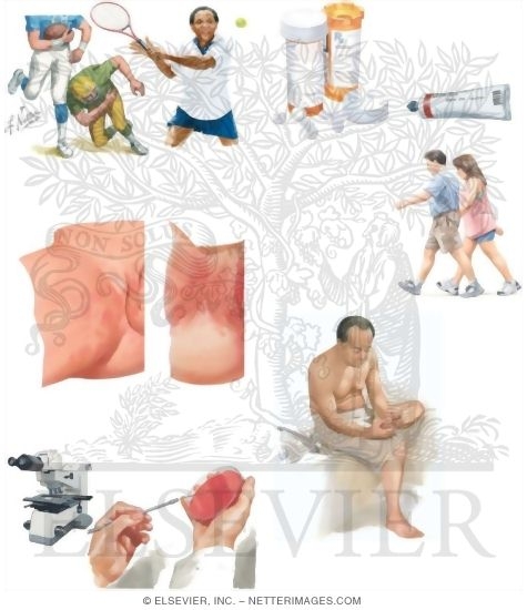 Managing Your Tinea Cruris