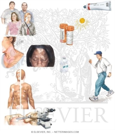 Watermarked preview of unlabeled image: Managing Vitiligo