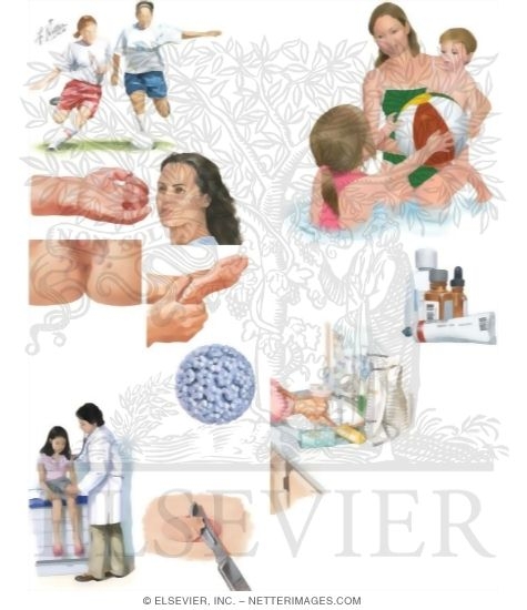 Watermarked preview of unlabeled image: Managing Your Warts