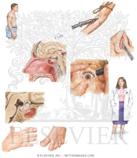 Watermarked preview of unlabeled image: Managing Your Acromegaly