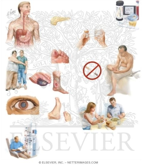 Watermarked preview of unlabeled image: Managing Your Diabetes Mellitus Type 2