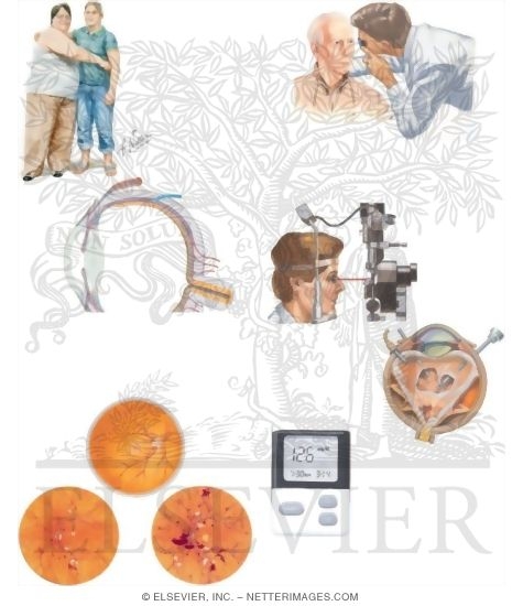 Watermarked preview of unlabeled image: Managing Your Diabetic Retinopathy