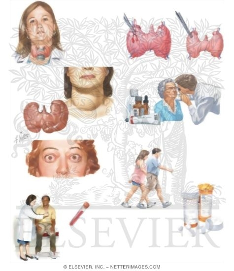 Watermarked preview of unlabeled image: Managing Your Graves' Disease