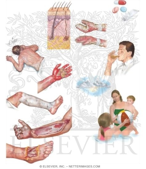 Watermarked preview of unlabeled image: Managing Your Burns