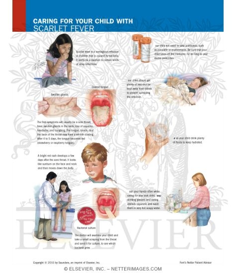 Watermarked preview of labeled image: Caring for Your Child With Scarlet Fever