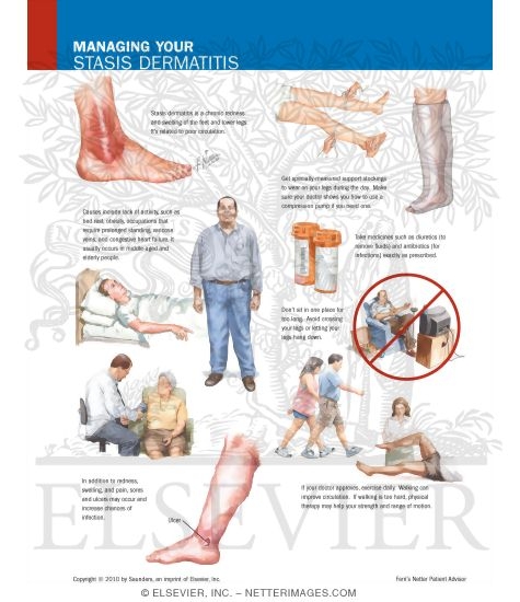 Managing Your Stasis Dermatitis