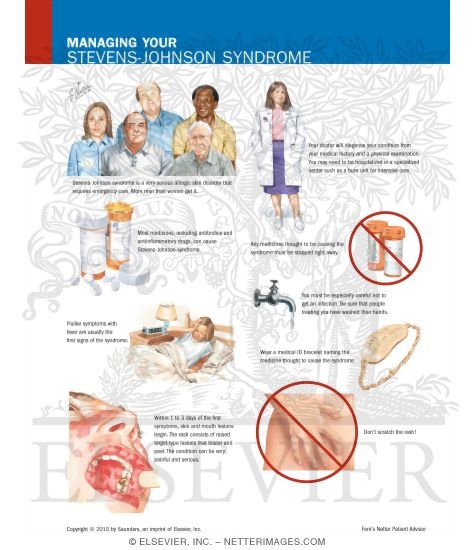 Managing Your Stevens Johnson Syndrome