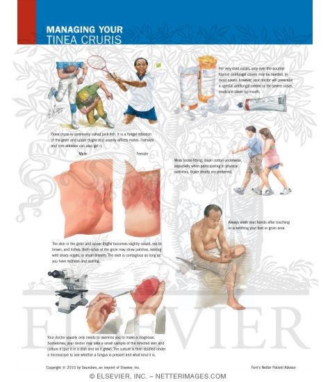 Managing Your Tinea Cruris