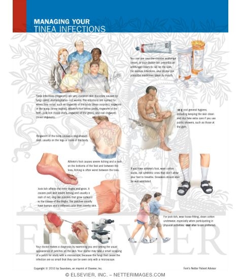 Watermarked preview of labeled image: Managing Your Tinea Infections