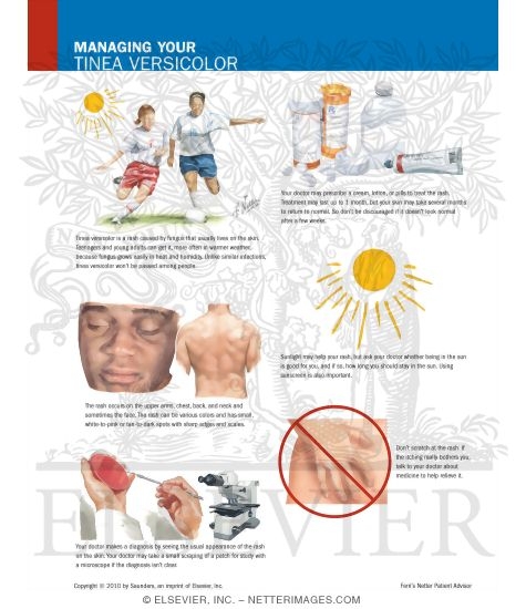 Managing Your Tinea Versicolor 