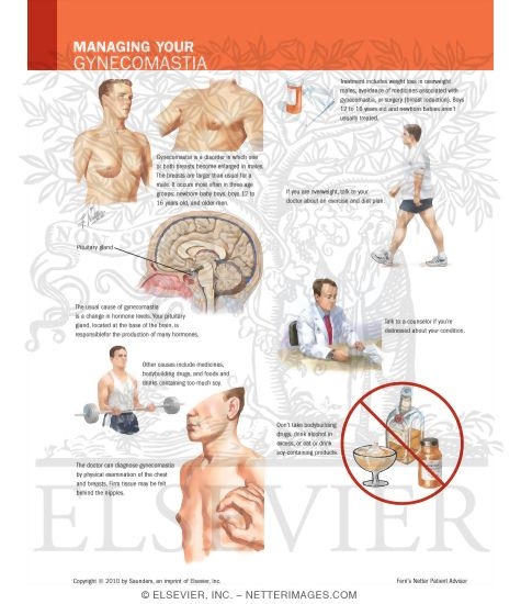 Watermarked preview of labeled image: Managing Your Gynecomastia