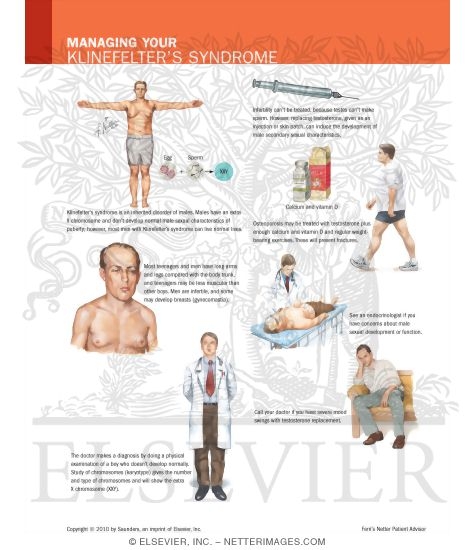 Klinefelter Syndrome Physical Features