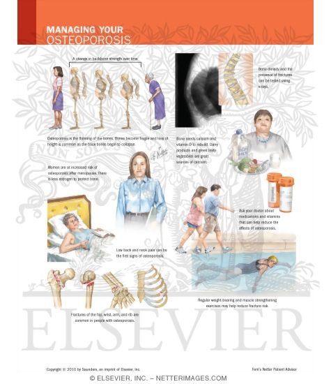 Watermarked preview of labeled image: Managing Your Osteoporosis