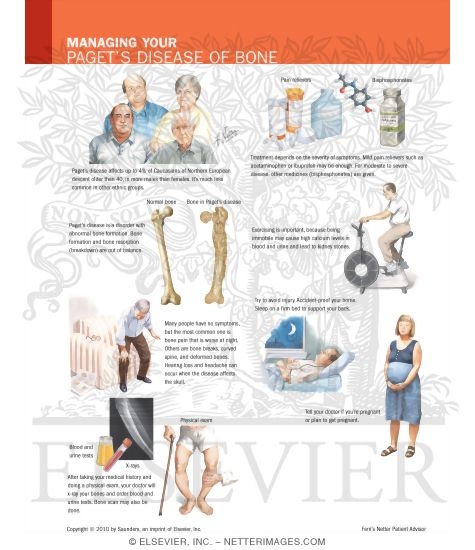 Watermarked preview of labeled image: Understanding Your Paget's Disease of Bone