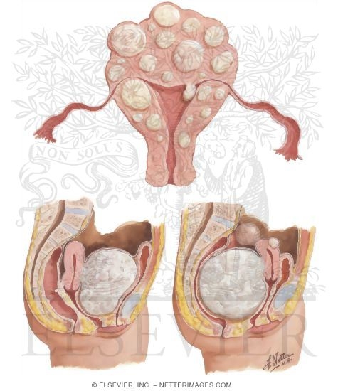 Watermarked preview of unlabeled image: Myomectomy In Treatment of Infertility
